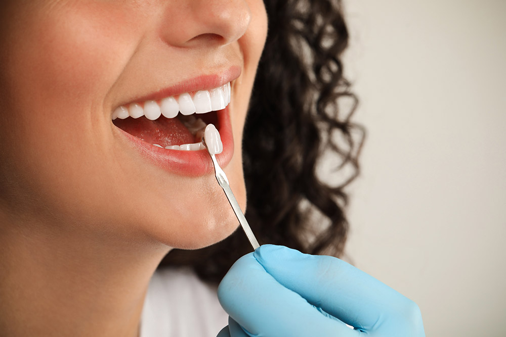 Veneers
