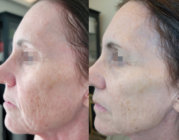 Opus Plasma Skin Treatment in Thousand Oaks