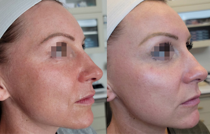 Opus Plasma Skin Treatment in Thousand Oaks