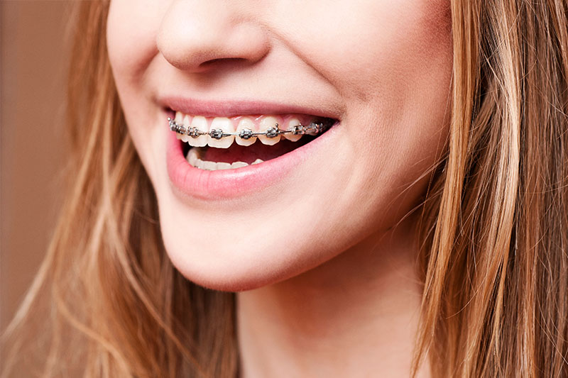 Orthodontics in Thousand Oaks