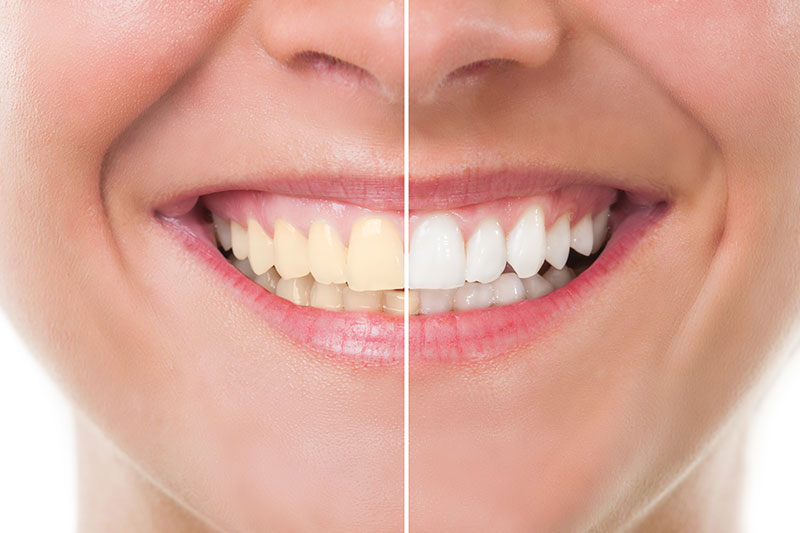 Teeth Whitening in Thousand Oaks